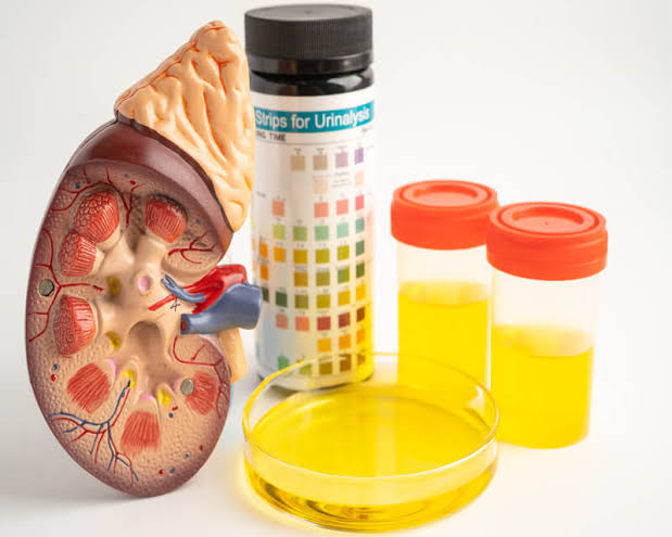 Urine Analysis